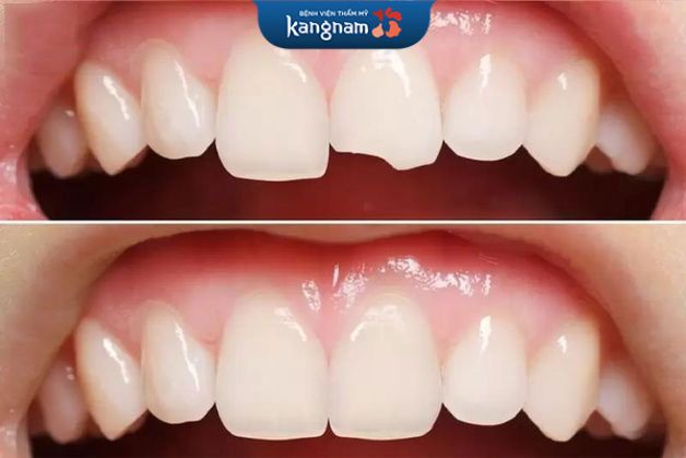 Hai răng cửa bị mẻ sau tai nạn cũng phục hình lại đẹp sau hàn răng thẩm mỹ