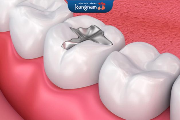 Giá vật liệu trám răng gic thấp phù hợp nhiều đối tượng khách hàng