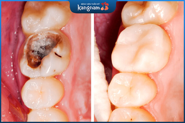 Trá răng sâu nặng cho khách hàng nữ