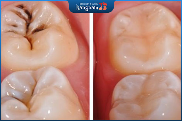 Kết quả khách hàng sau khi trám răng sâu tại Bệnh viện Kangnam