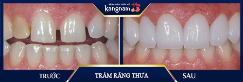 Răng bị thưa, kẽ hở lớn đã không còn là khuyết điểm làm chị Linh (Nghệ An) phải tự ti mỗi khi giao tiếp, cười với bạn bè, đồng nghiệp trám răng thưa thẩm mỹ