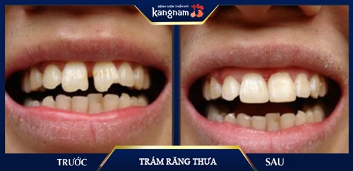 Hình ảnh trám răng thẩm mỹ khắc phục ngay tình trạng răng thưa mọc lệch bẩm sinh của anh Huy (Hà Nội) trám răng thưa