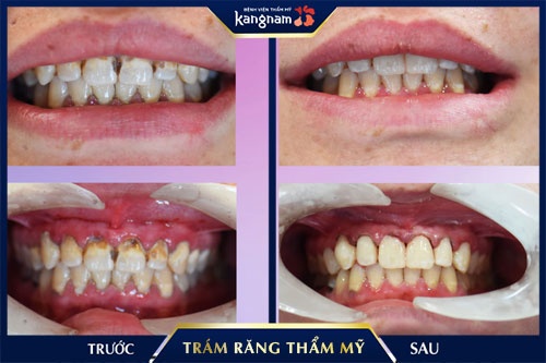 trám răng vĩnh viễn trám răng vĩnh viễn
