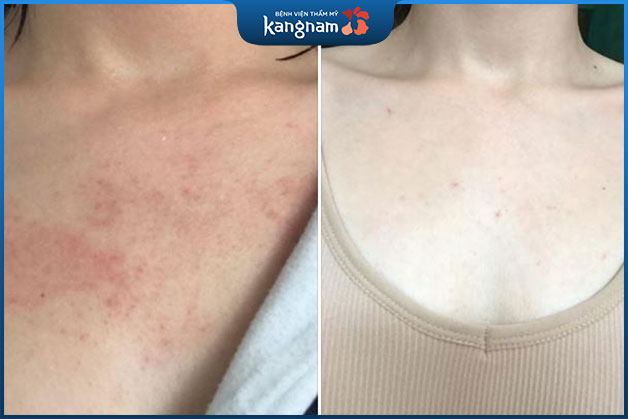 Hiệu quả trị sạch dứt điểm mụn ở ngực và cổ bằng công nghệ hiện đại