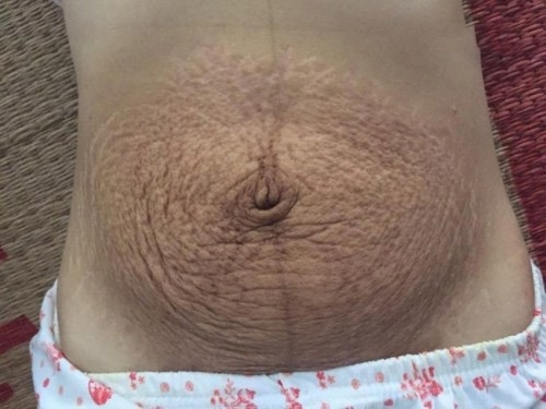 Trường hợp thâm rạn nặng sau sinh không thể tự hết mà cần phải điều trị bằng phương pháp phù hợp trị thâm da bụng sau sinh