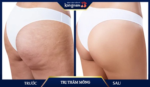 trị thâm mông 