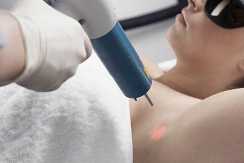 Trị thâm nách bằng Laser tại Kangnam diễn ra an toàn, đúng chuẩn Bộ Y Tế trị thâm nách bằng laser review