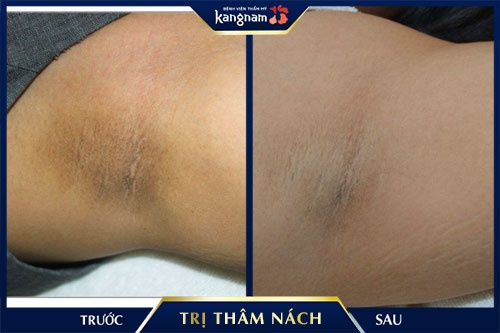 trị thâm nách bao nhiêu tiền trị thâm nách bao nhiêu tiền