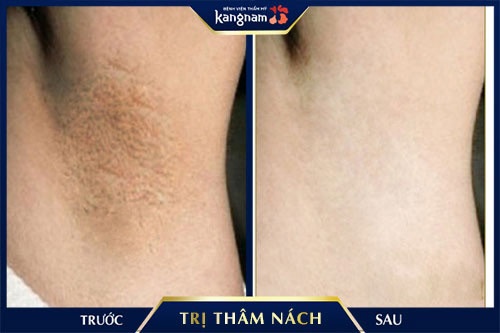 trị thâm nách cho bà bầu