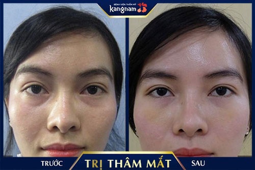trị thâm quầng mắt bằng laser có tốt không