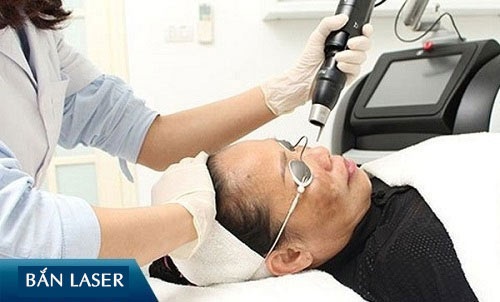 trị thâm quầng mắt bằng laser review