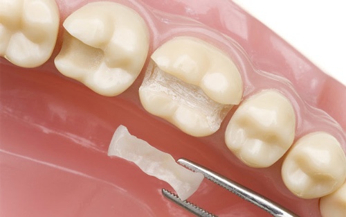 tự trám răng tại nhà