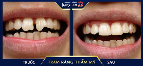vật liệu trám răng vật liệu trám răng