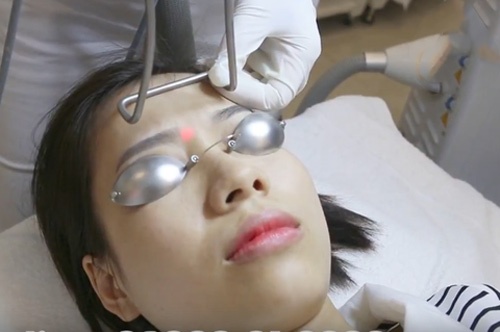 Triệt gọn lông mày ở vị trí ấn đường là phương pháp được nhiều người lựa chọn