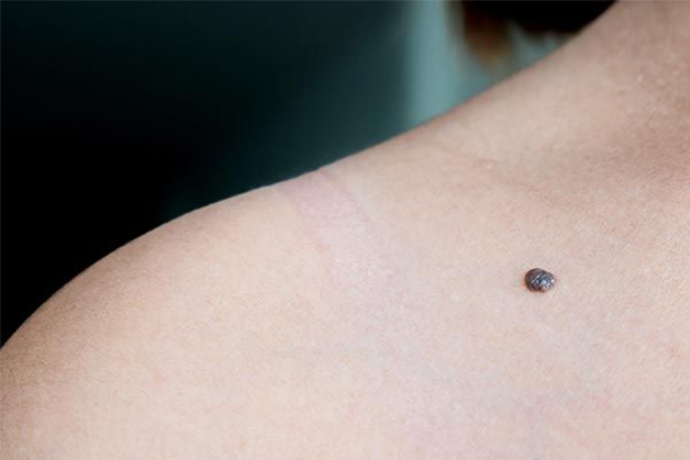 Nốt ruồi trên vai tốt hay xấu