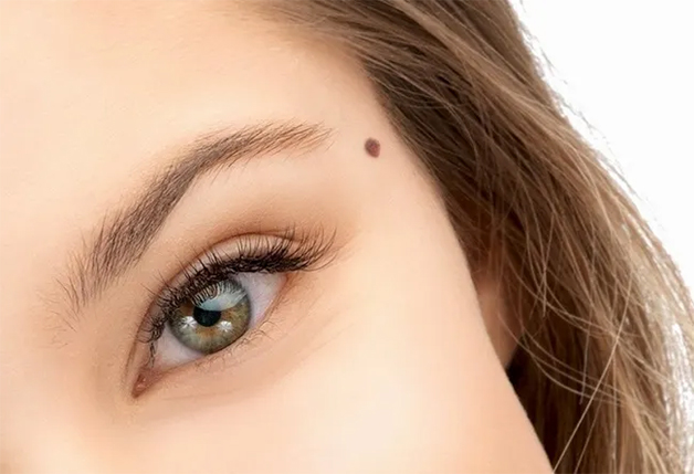 Nốt ruồi mọc ở thái dương không hiếm và mang nhiều điềm báo tương lai