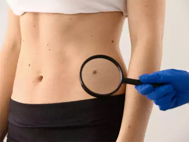 Nốt ruồi ở hông trái phụ nữ thường biểu lộ giới tính con cái của bạn