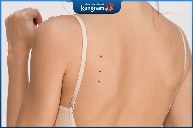 3 nốt ruồi thẳng hàng