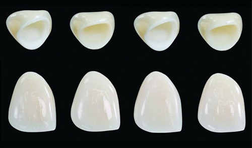 bọc răng sứ bao lâu thì hỏng