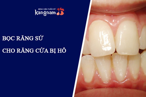 Bọc răng sứ cho răng hô phù hợp với người vẩu nhẹ, khớp cắn lệch ít bọc răng sứ cho răng hô