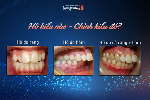 Niềng răng khắc phục được tình trạng hàm hô do răng mọc lệch, khuôn hàm trên đưa ra phía trước nhiều bọc răng sứ chữa hô