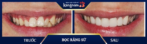 Bọc răng sứ vừa hết hô vừa giúp bạn vệ sinh răng miệng dễ dàng hơn bọc răng sứ có hết hô không