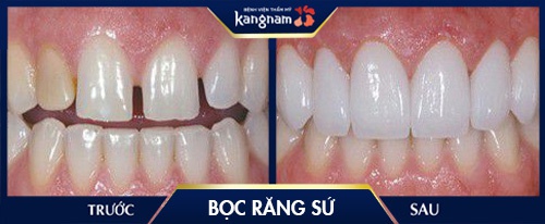 răng sứ thường có bền không 
