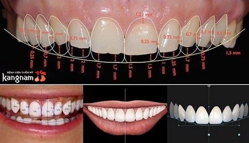 bọc răng sứ bao nhiêu tiền