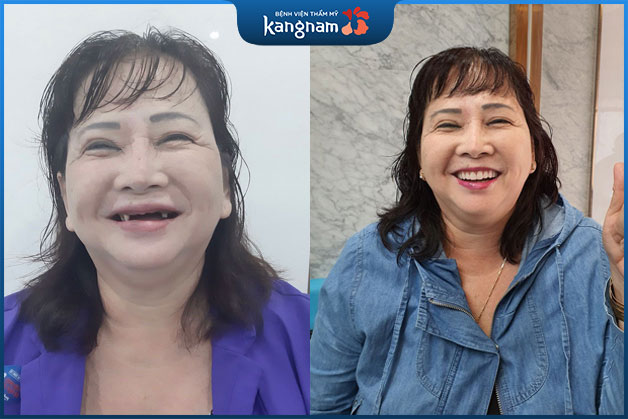 Răng cửa của cô Thoa bị mất gần hết đã được bọc răng sứ hoàn hảo