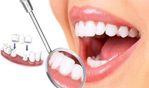 bọc răng sứ được bao lâu 