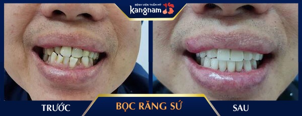 nguyên nhân tại sao bọc răng sứ bị hôi miệng? tại sao bọc răng sứ bị hôi miệng