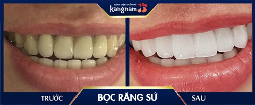 chi phí bọc răng sứ 