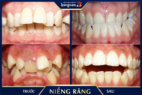 niềng răng khểnh có phải nhổ răng không 