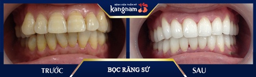 Cải thiện ngay đến 70% tình trạng hàm hô, khớp cắn lệch cấp độ nhẹ cho khách hàng chữa răng hô không cần niềng