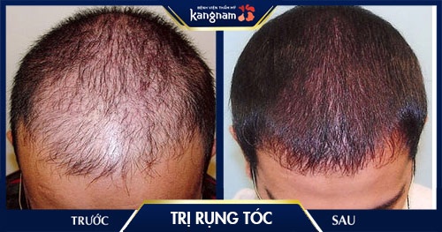 trị rụng tóc tại kangnam chữa rụng tóc