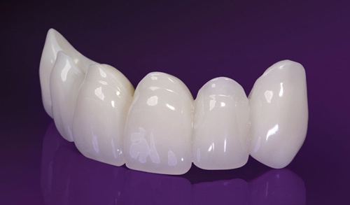 bảng giá răng sứ 