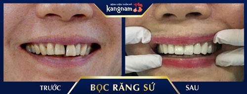 Trồng sứ Venus khắc phục hoàn toàn tình trạng răng thưa, hô răng sứ venus có tốt không