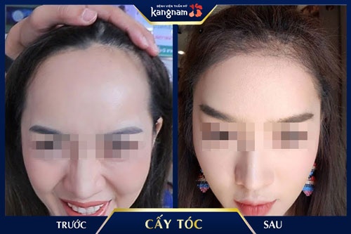 hói trán có chữa được không hói trán có chữa được không
