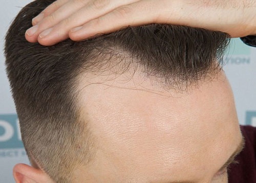 hói trán hói trán