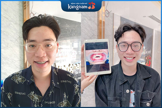 Răng cửa mọc lệch 2 hàm trên dưới bác sĩ đã tiến hàng nhổ bớt răng và đeo niềng để chỉnh nha toàn diện. Kết quả sau 1 năm 8 tháng niềng răng đã thay đổi hoàn toàn cấu trúc ổ răng trước đây và làm khách hàng hài lòng