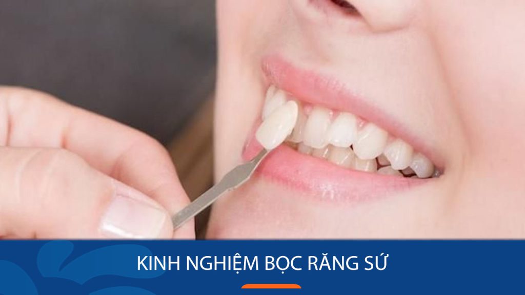 5 kinh nghiệm bọc răng sứ thẩm mỹ Đẹp – An Toàn