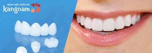 bảng giá bọc răng sứ 