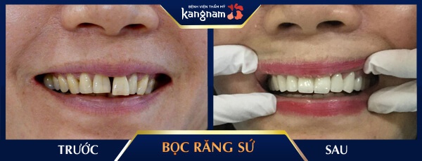 khắc phục tình trạng răng sứ bị hôi răng sứ bị hôi