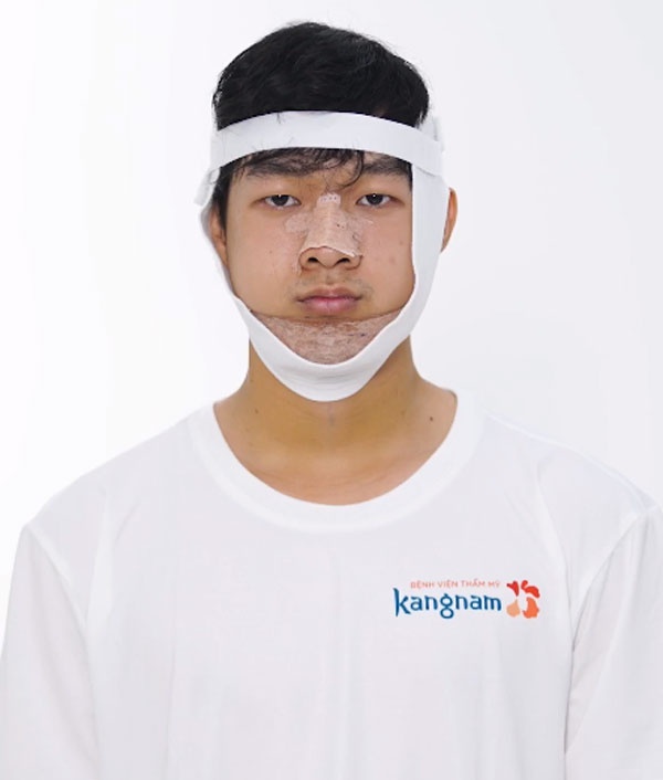 minh hoang sau phẫu thuật