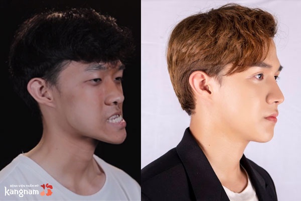 Góc nghiêng phải: Xương hàm lệch méo đã được thu gọn cân xứng, mũi cao tự nhiên