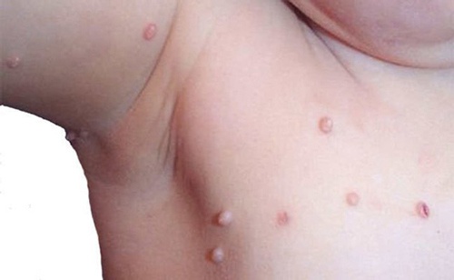 Trẻ em có hệ miễn dịch yếu nên rất dễ mắc phải mụn cóc mụn cóc có bị lây không