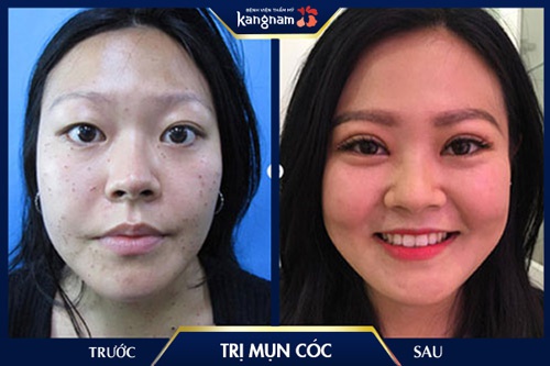 trị mụn tại Kangnam mụn cóc ở tay có lây không