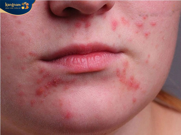 Nổi mụn trứng cá quanh miệng có thể gặp ở cả nam giới và nữ giới