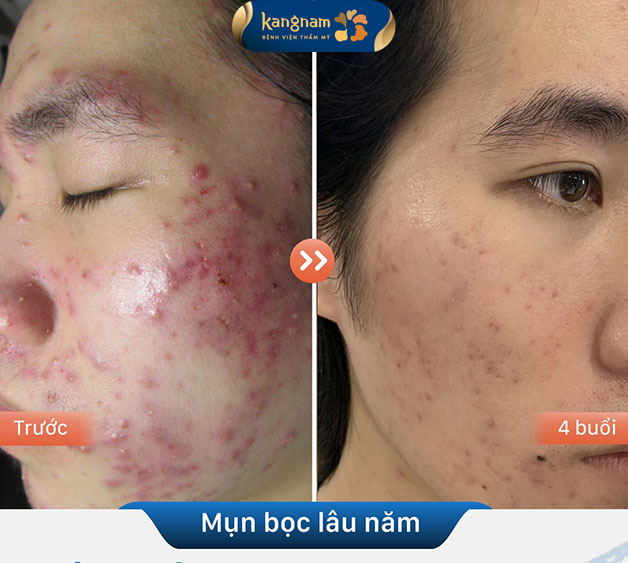 Kết quả trước và sau khi khách hàng điều trị mụn tại Kangnam