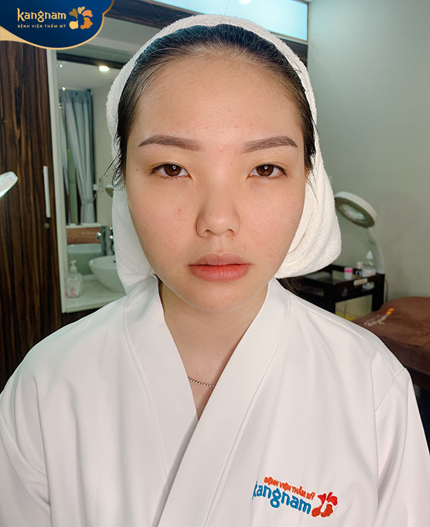 Kết quả sau điều trị sạch hoàn toàn mụn bọc, trứng cá quanh miệng và cằm